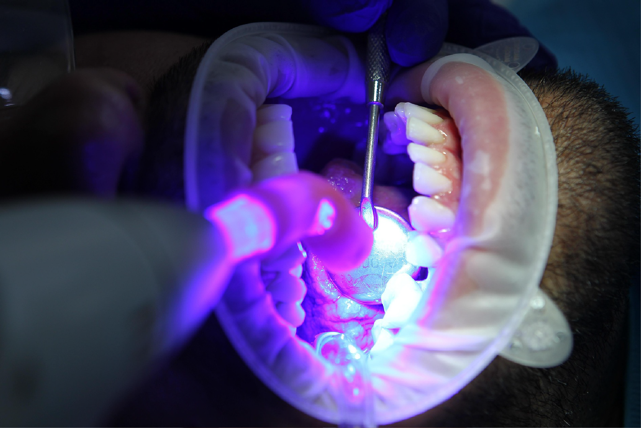Connor Family Dentistry Teeth Whitening